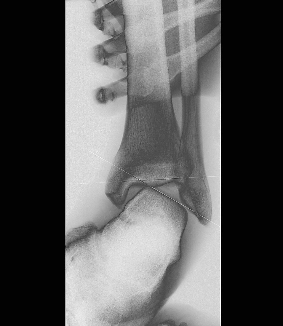 Sprained ankle,X-ray