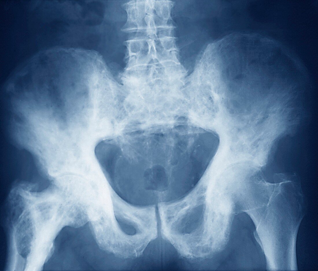 Pelvis in Paget's disease,X-ray