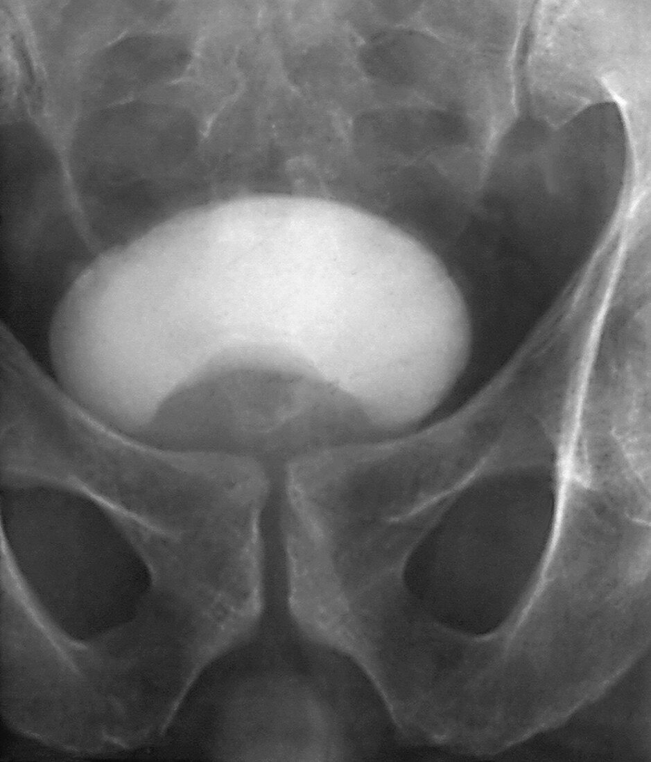 Prostate disorder,X-ray urogram