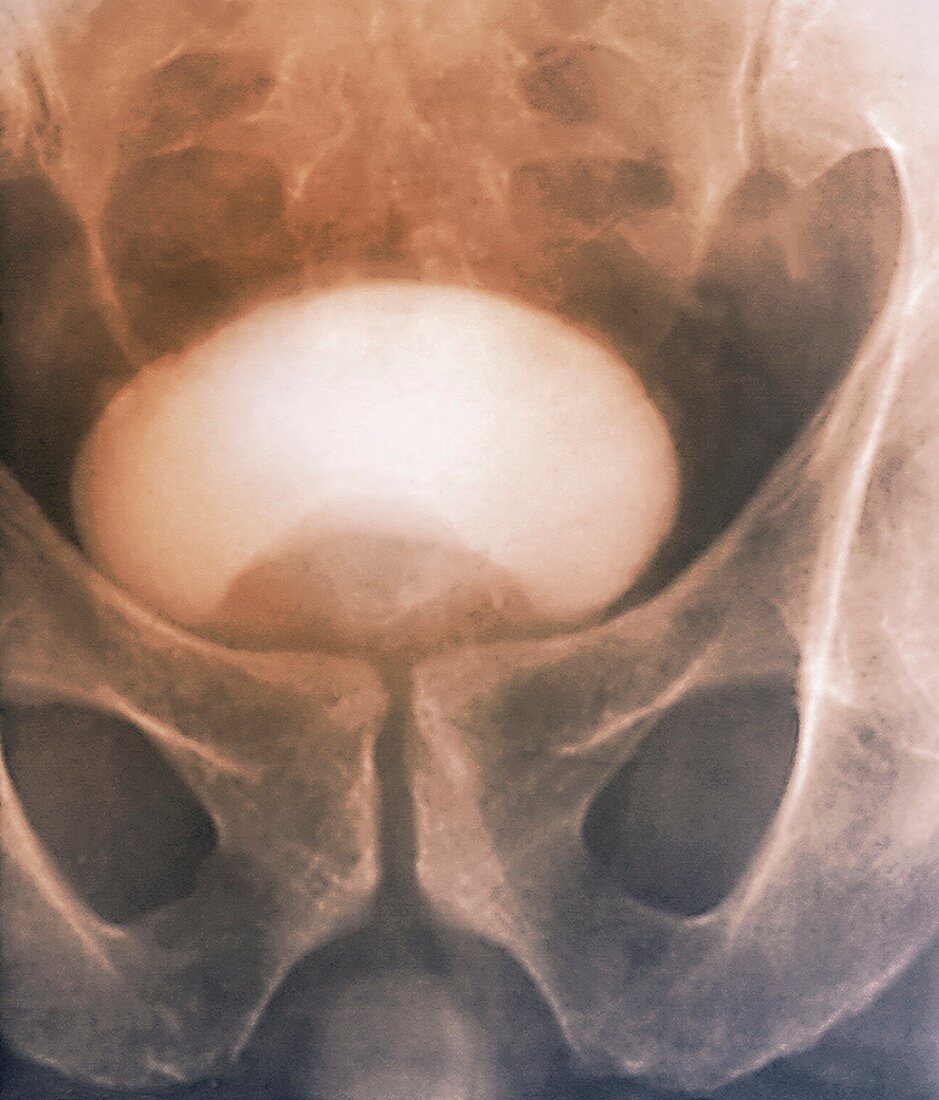 Prostate disorder,X-ray urogram