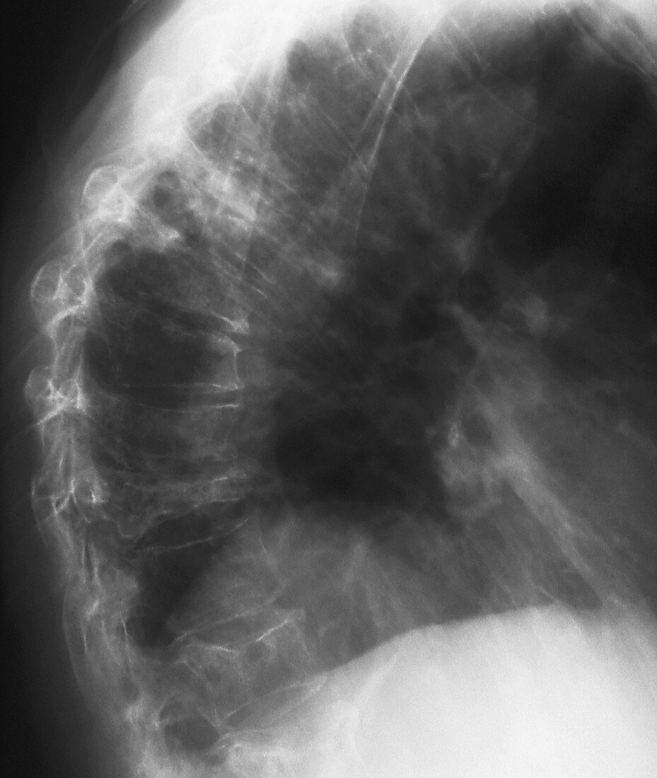 Spine in bone marrow cancer,X-ray