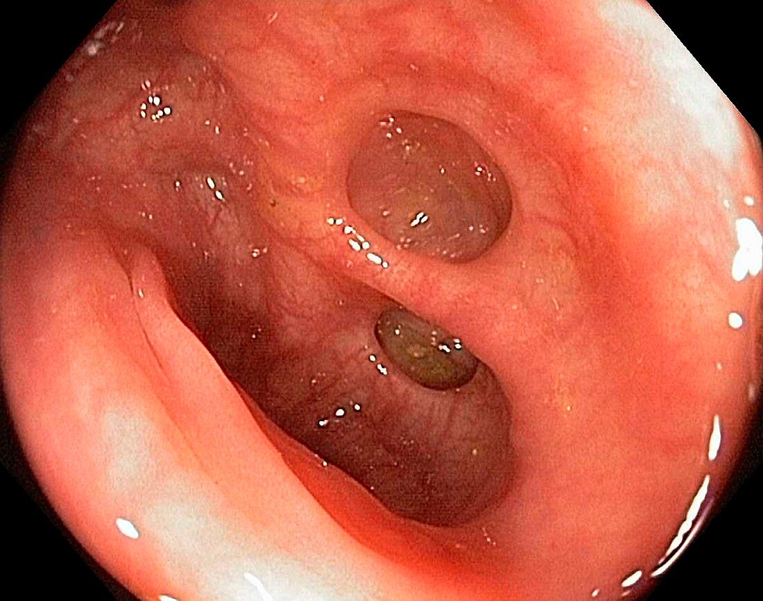 Diverticula in the sigmoid colon
