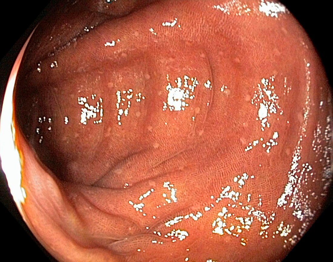 Pigmentation (melanosis) of the colon