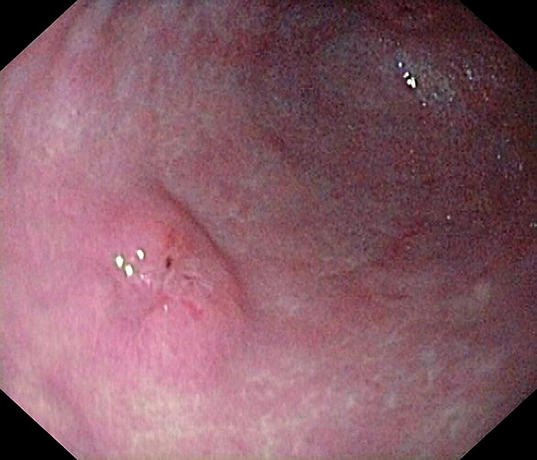 Early gastric cancer in the stomach