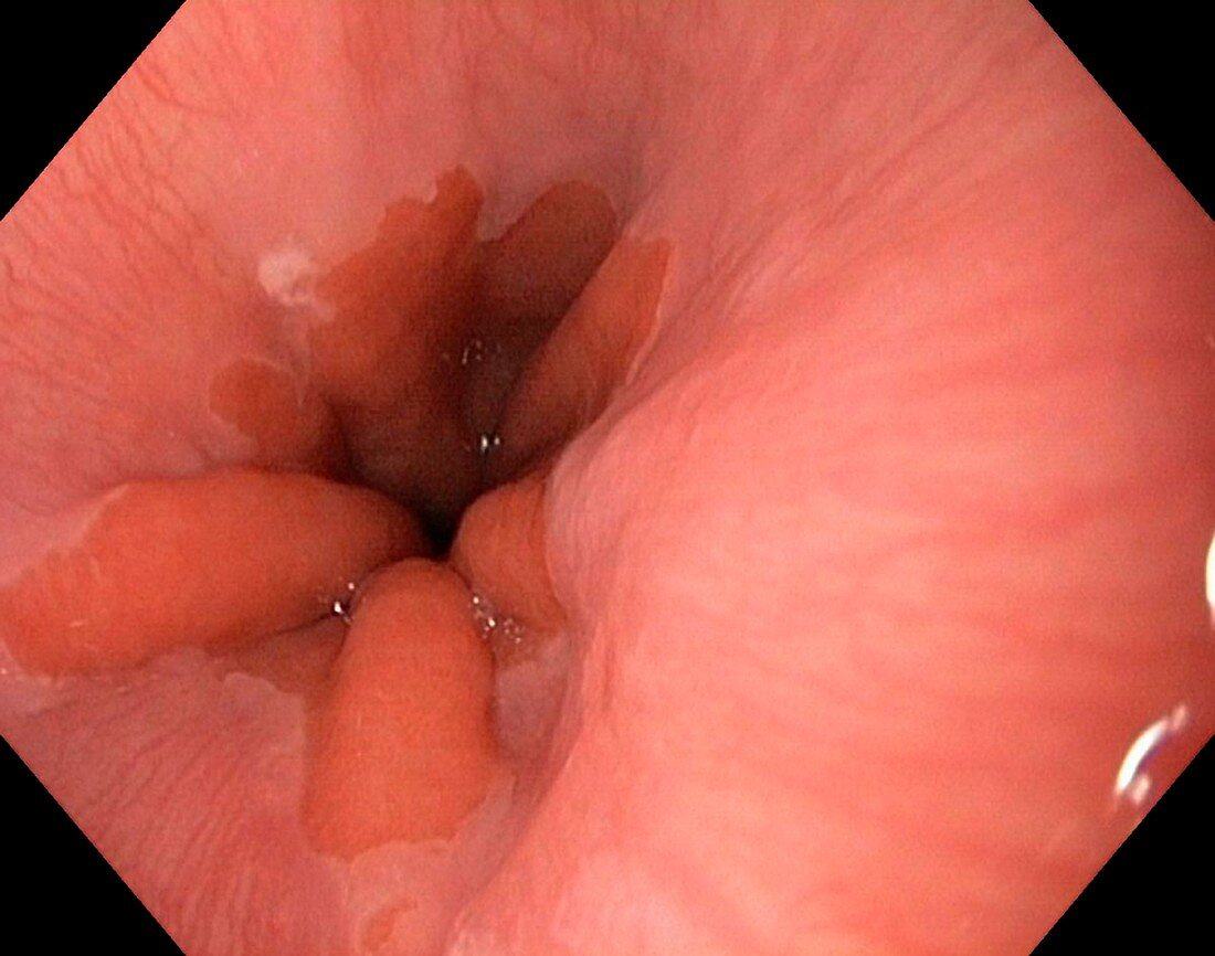 Healthy cardia of the stomach