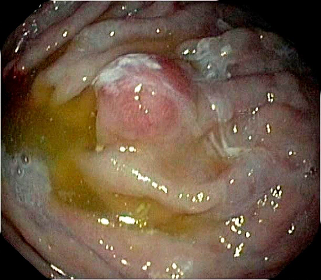 Carcinoid tumour in the stomach