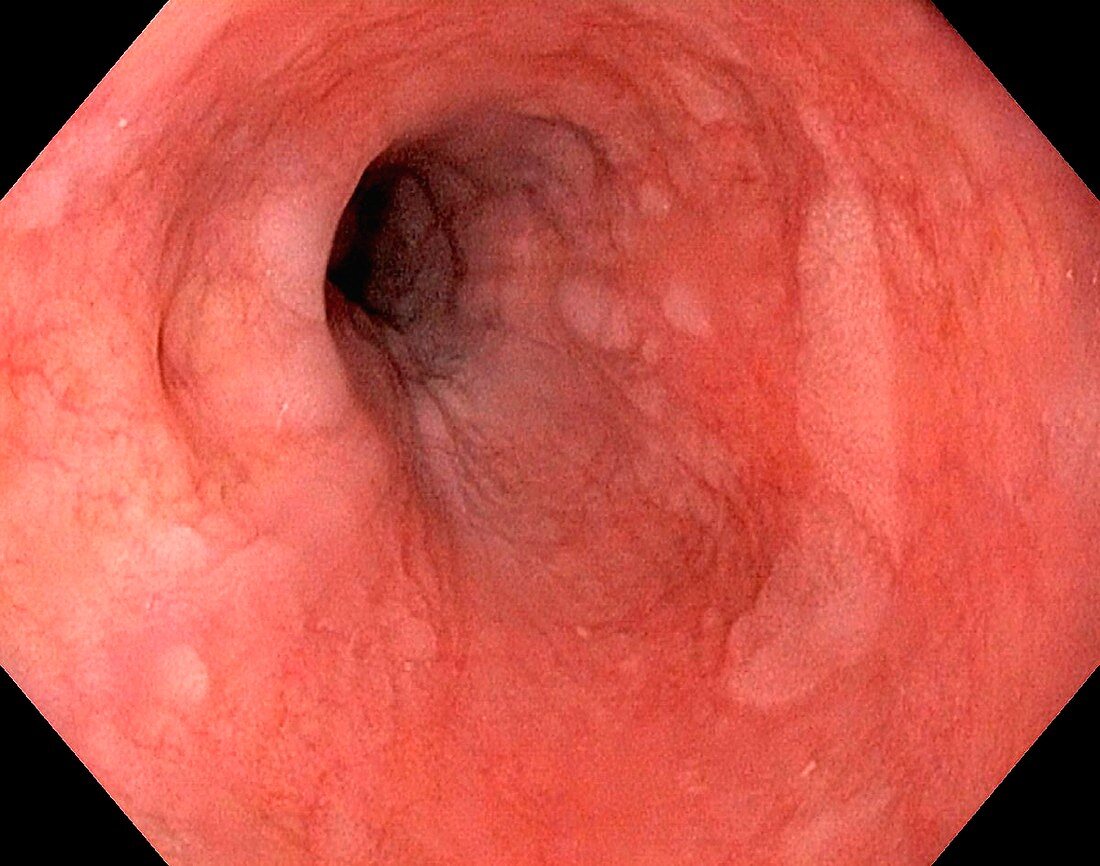 Glycogenic acanthosis in oesophagus