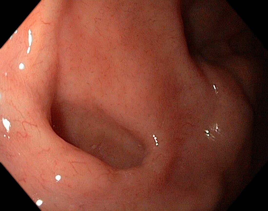 Diverticulum in the stomach