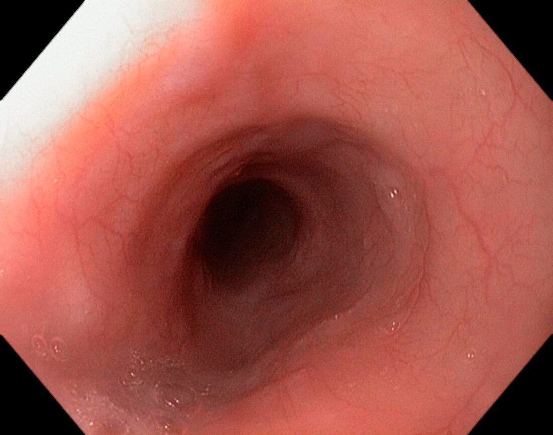 Healthy oesophagus