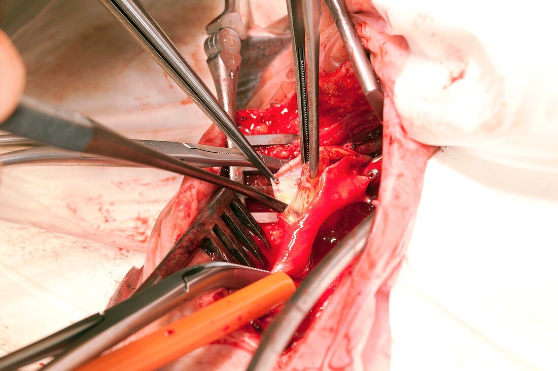 Carotid endarterectomy surgery