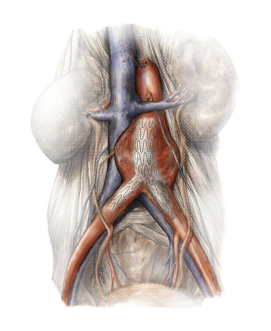 Abdominal aortic aneurysm,artwork