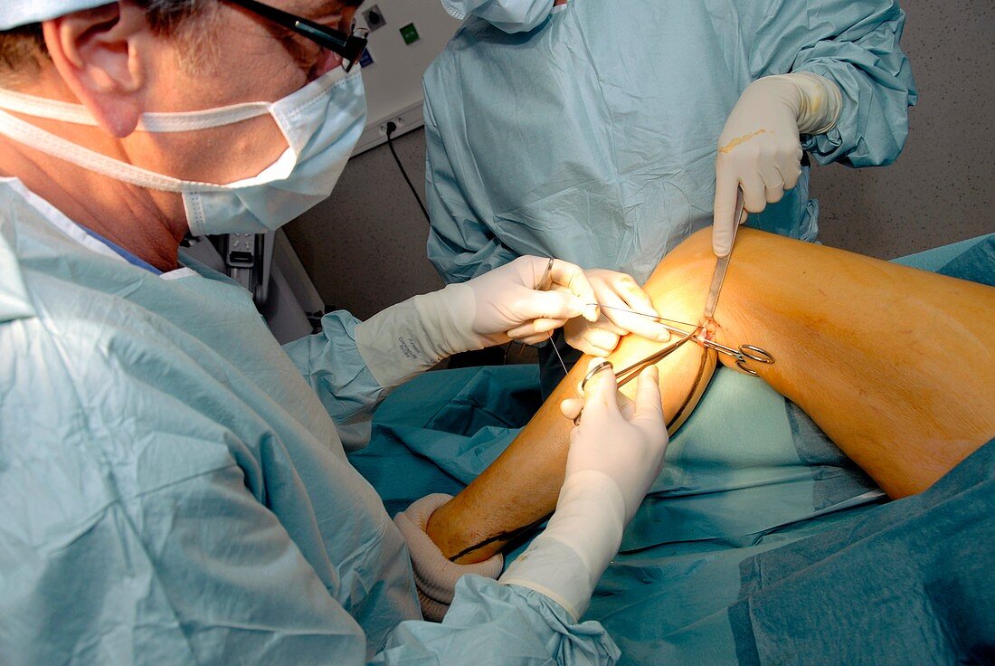 Varicose vein removal