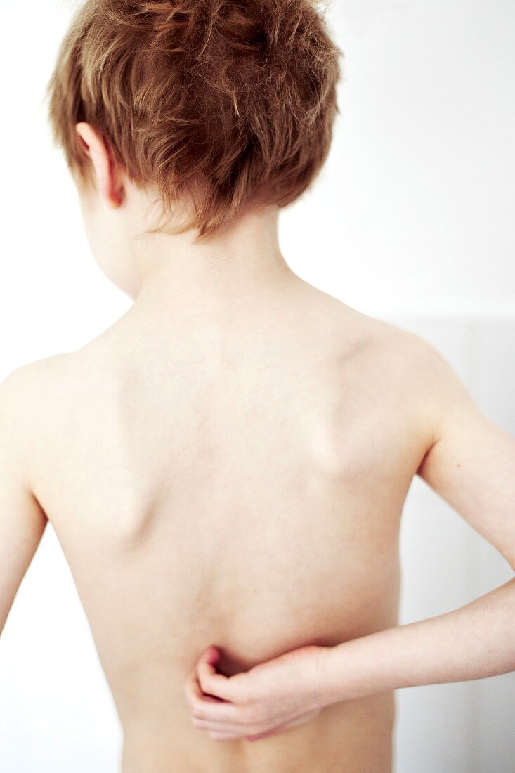Young boy scratching his eczema