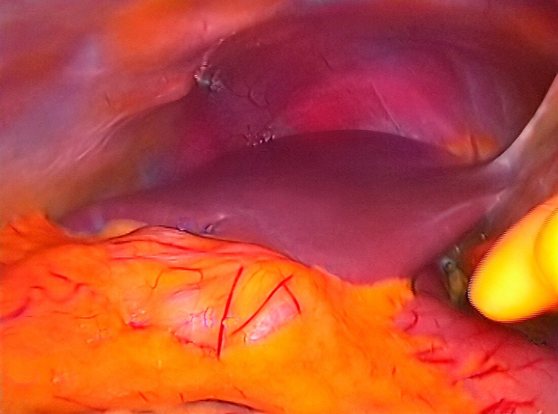 Healthy liver,laparoscopic view