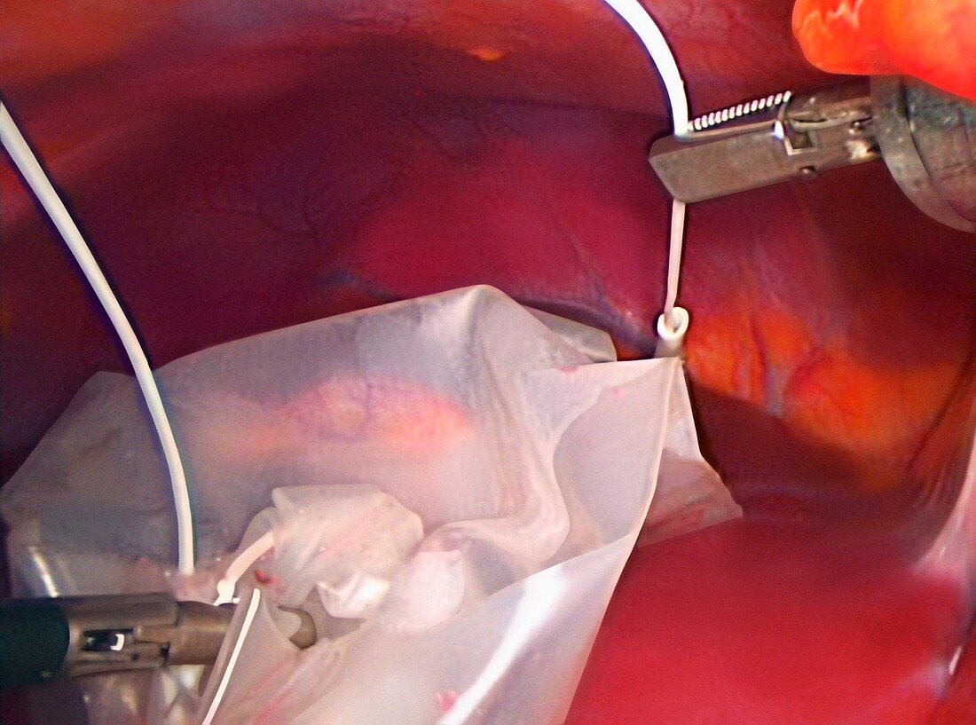 Gallbladder removal surgery