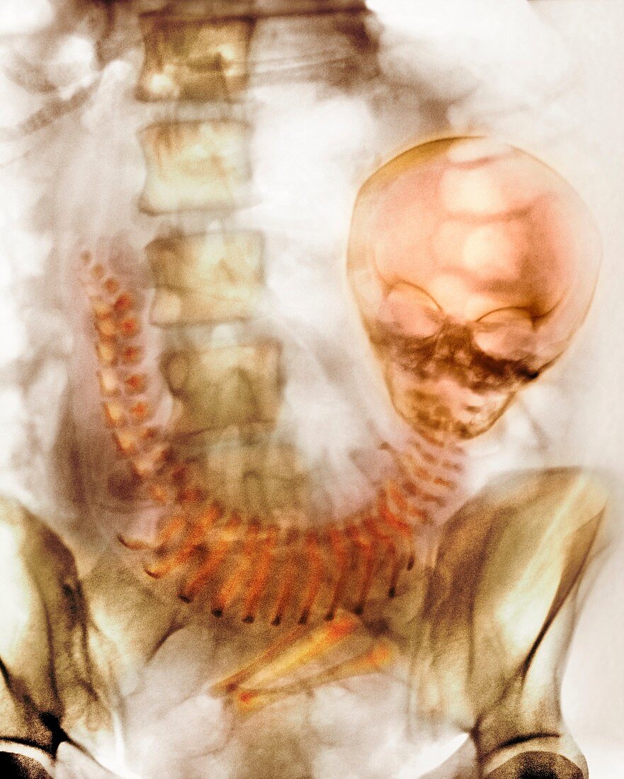 Full-term foetus,X-ray