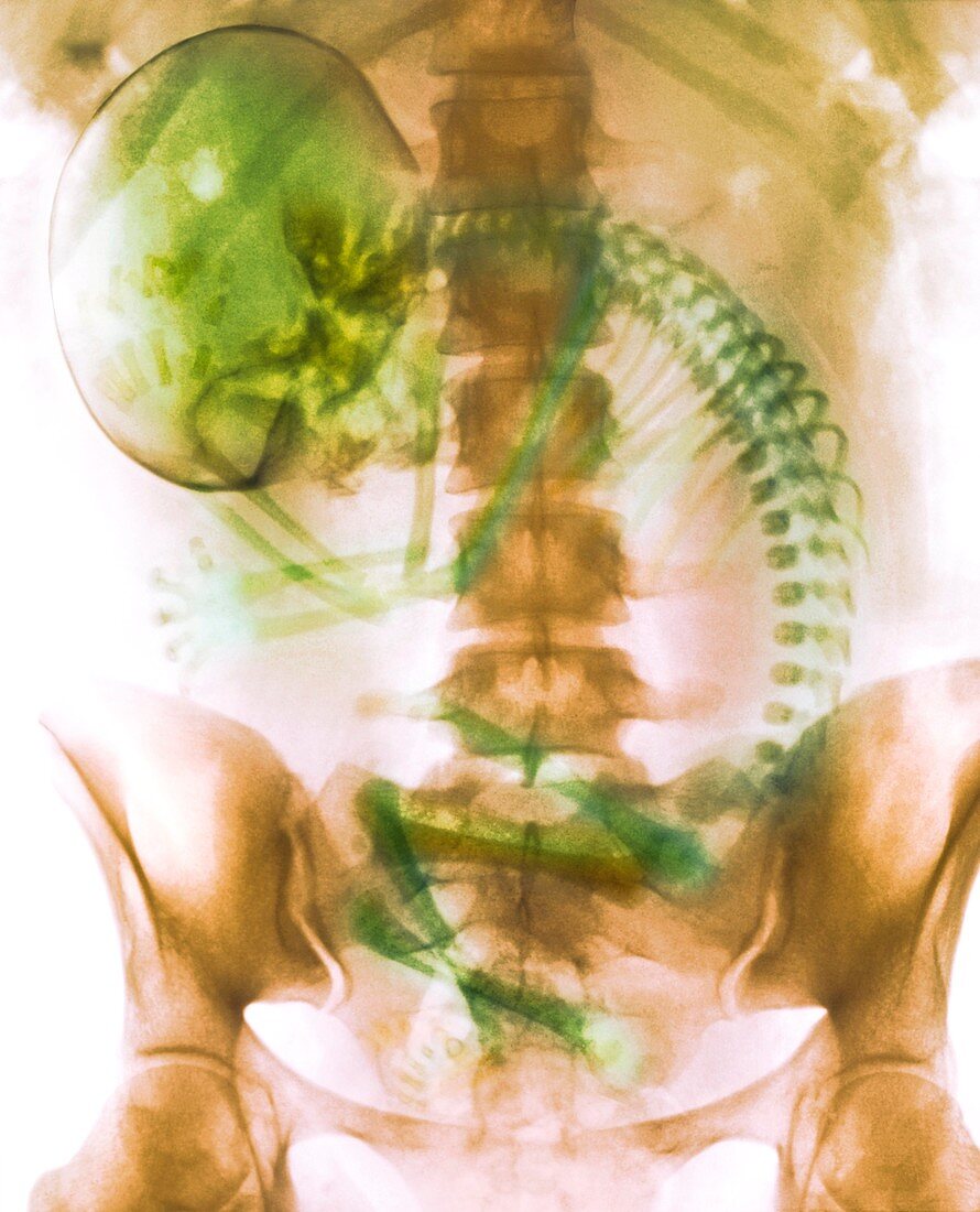 Full-term foetus,X-ray