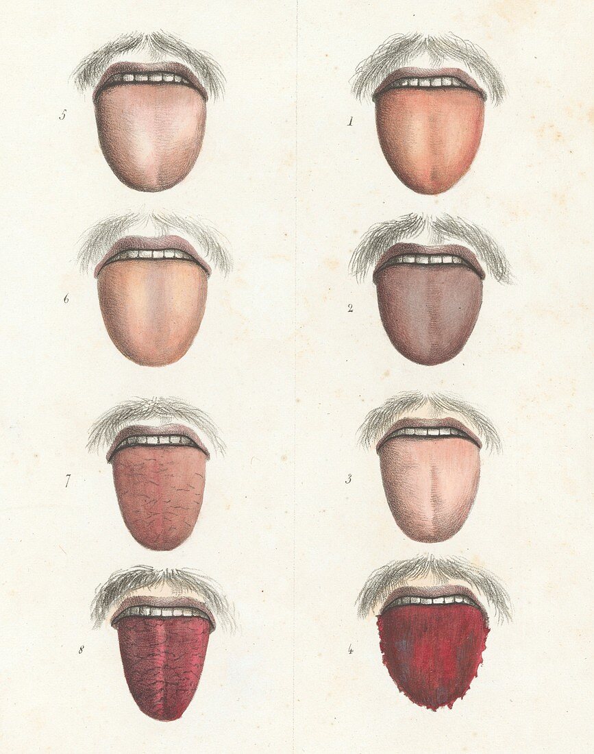 Yellow fever symptoms,19th century