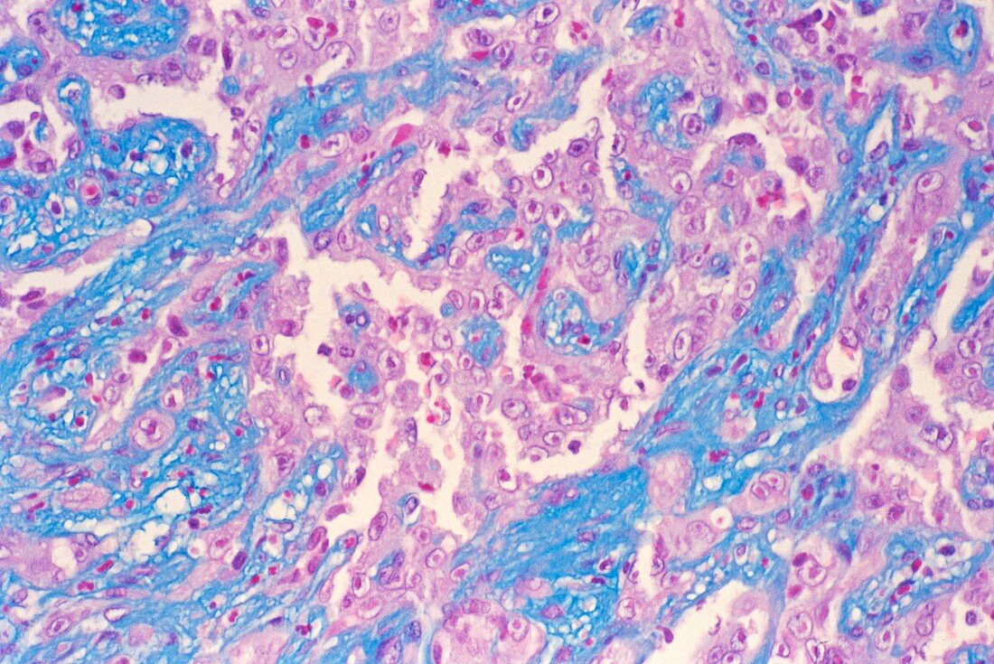 Angiosarcoma,light micrograph