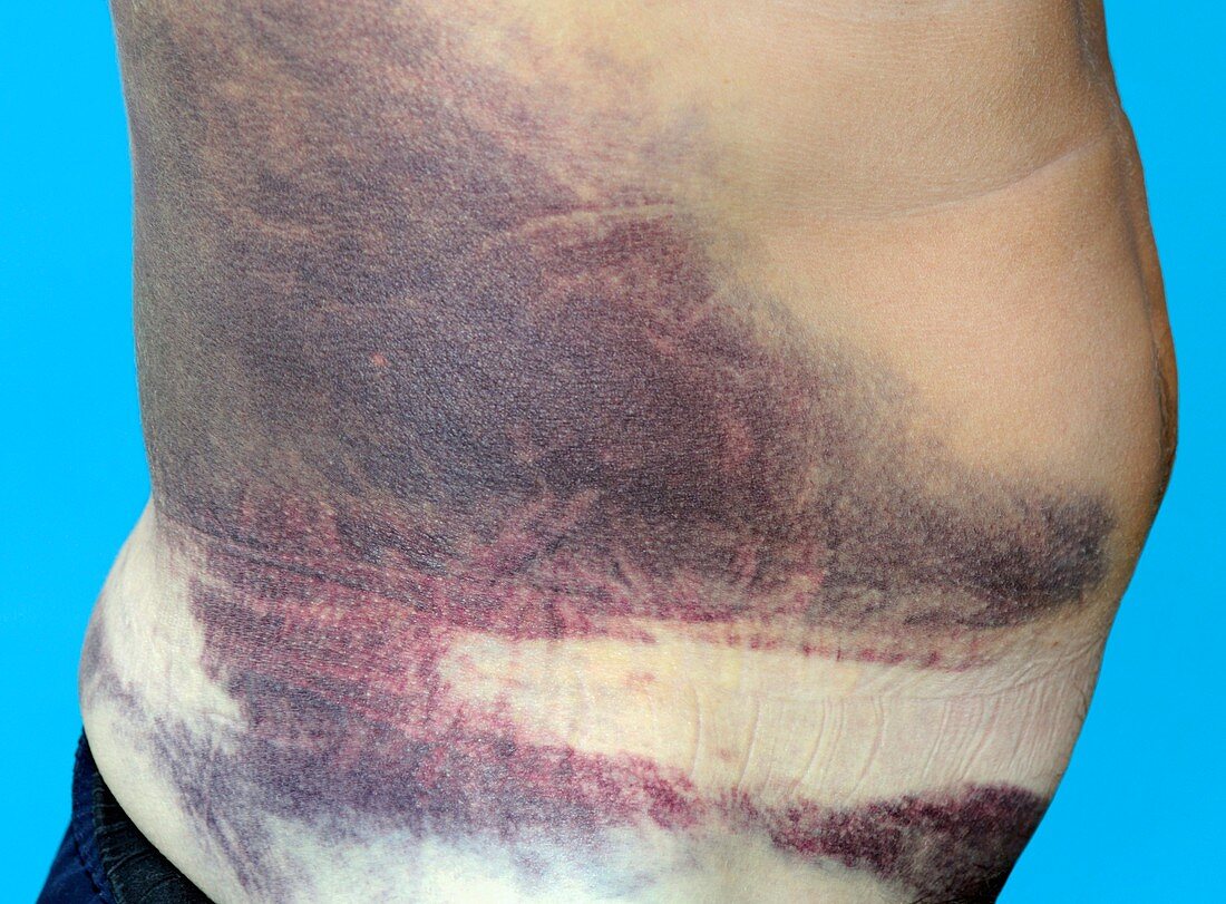 Bruising of the torso from a fall