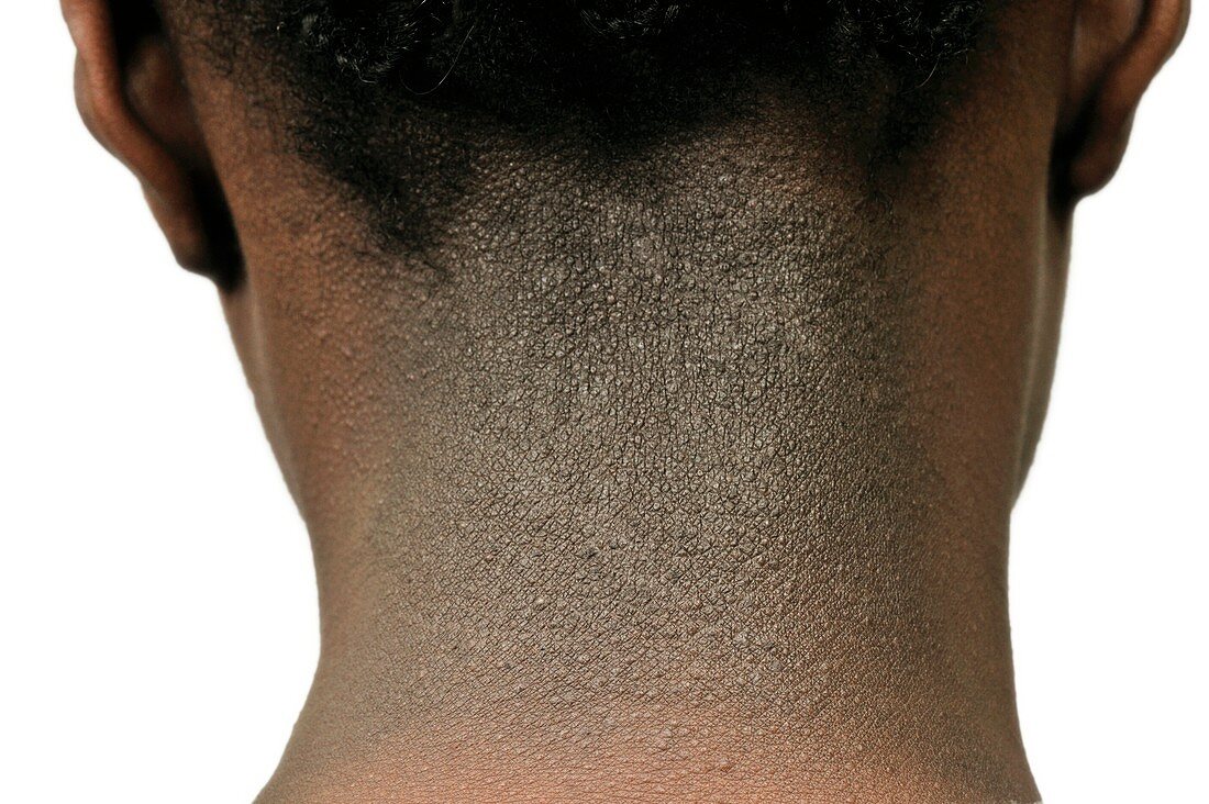 Hyperkeratosis of the neck