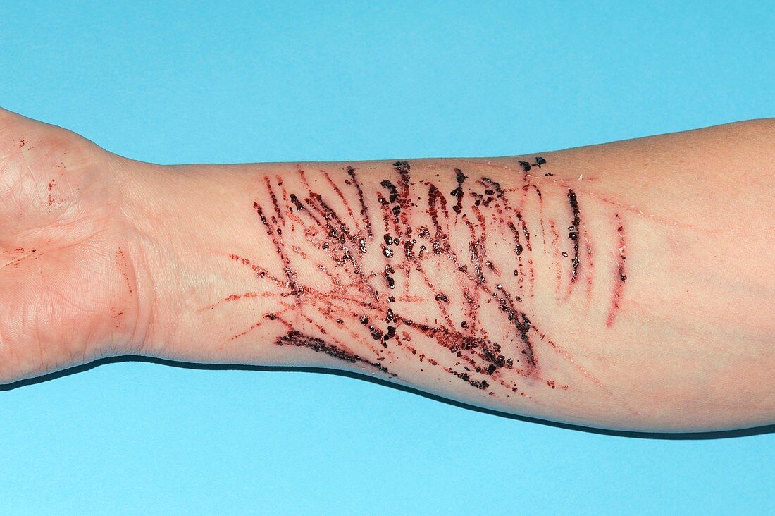 Self-harm lacerations on the arm