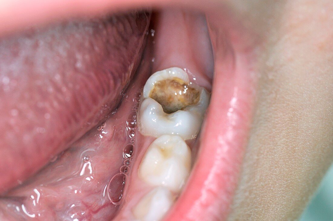 Tooth after dental filling dropped out