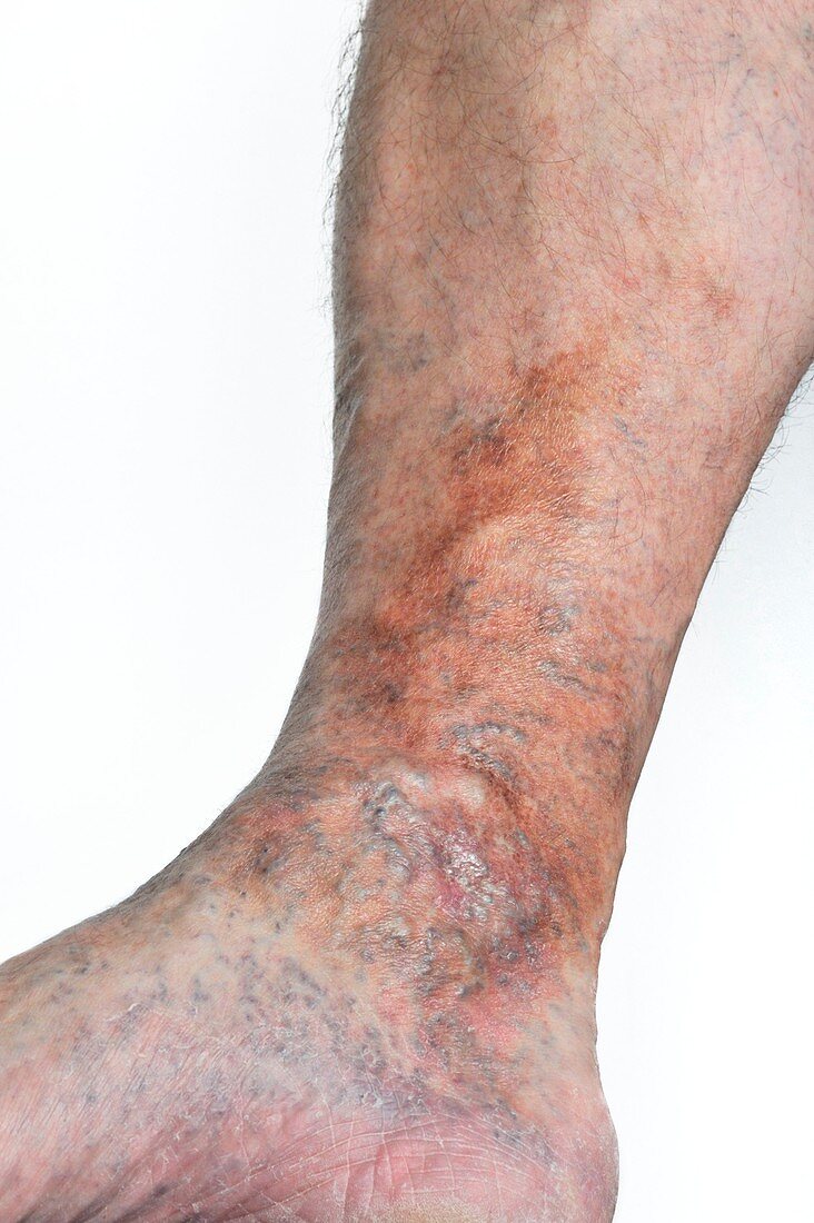 Varicose eczema on the leg