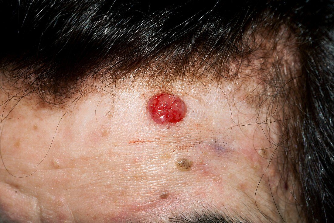 Basal cell skin cancer on the forehead