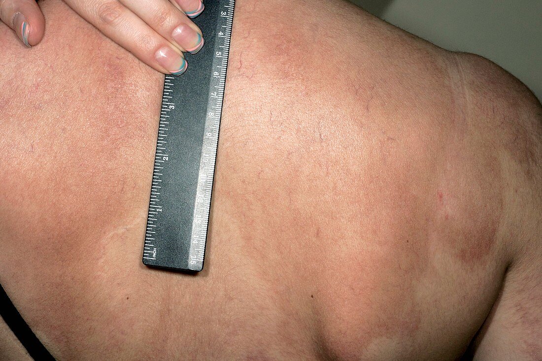 Psoriasis on the back after treatment