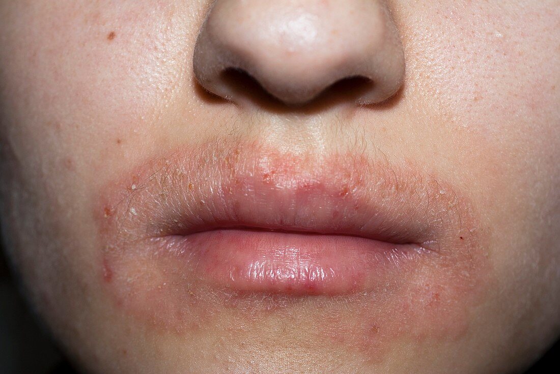 Dermatitis around the mouth
