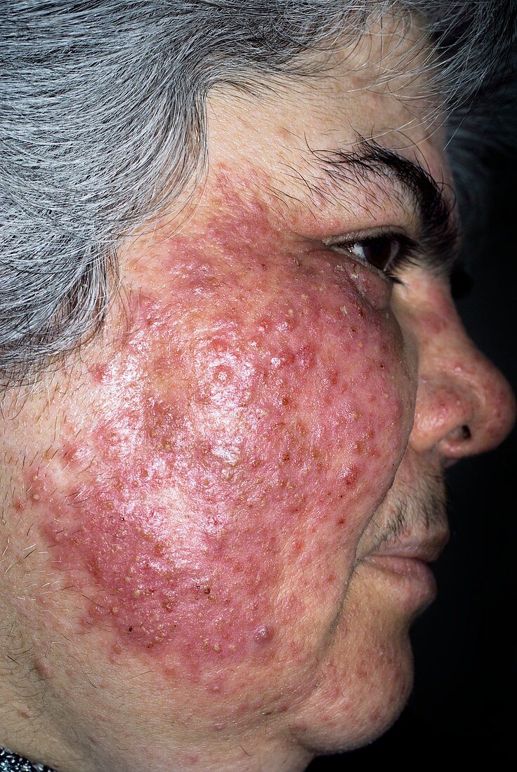 Acne rosacea on the face in a woman