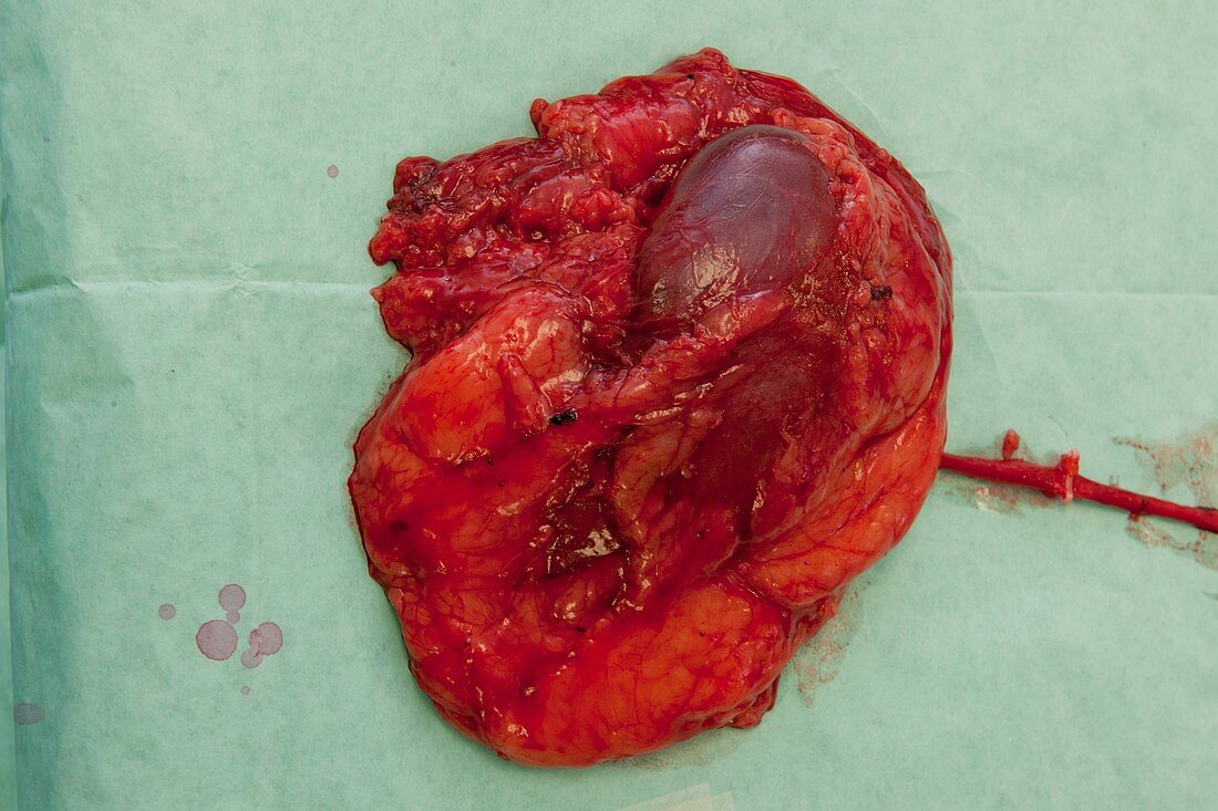 Excised cancerous kidney