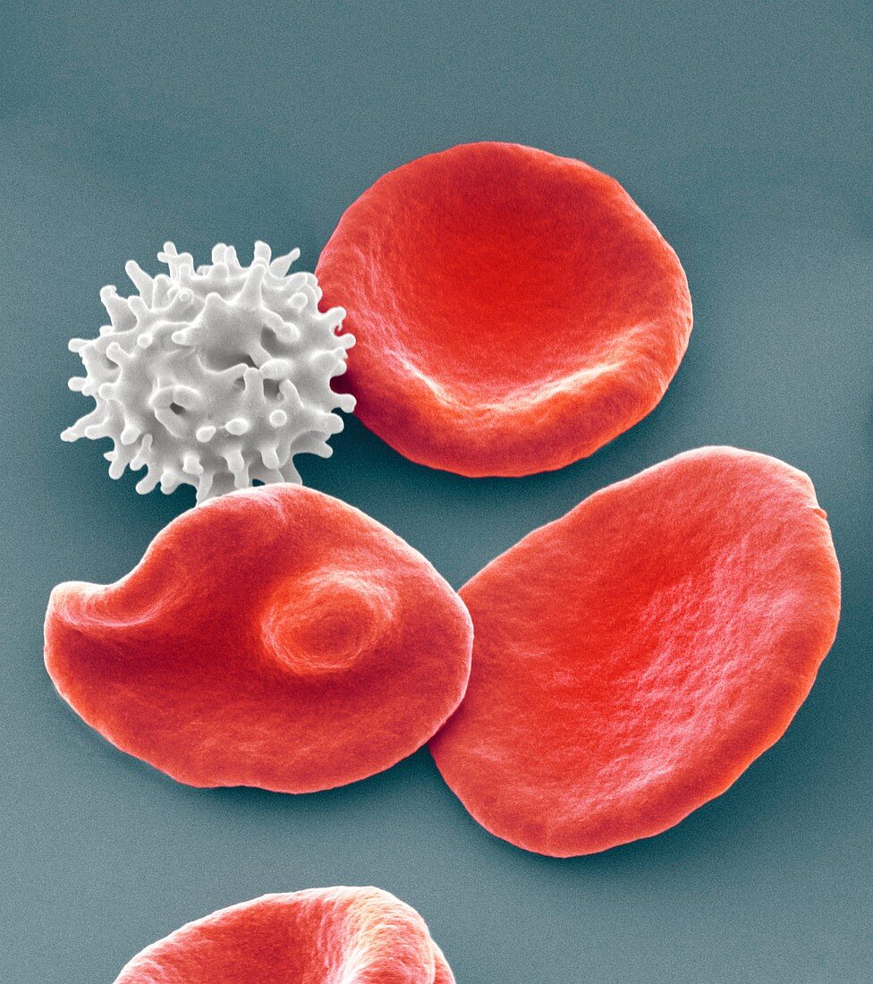 Healthy and crenated red blood cells,SEM