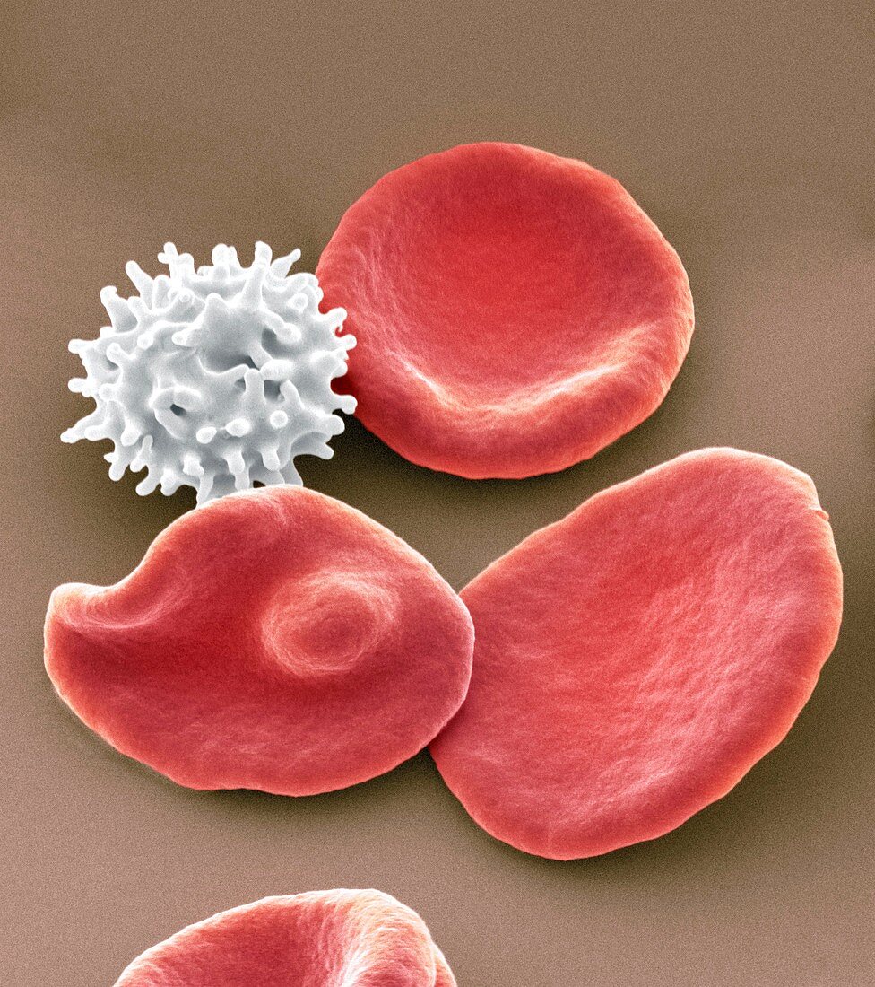 Healthy and crenated red blood cells,SEM