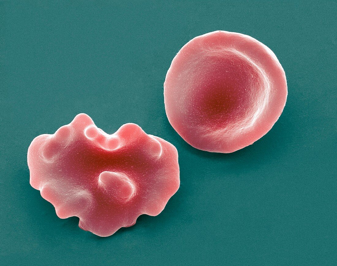 Healthy and crenated red blood cells,SEM