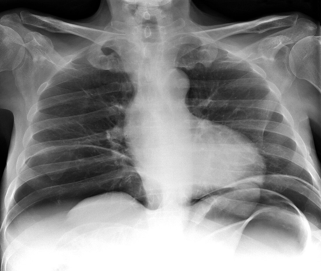 Abdominal air pockets,X-ray