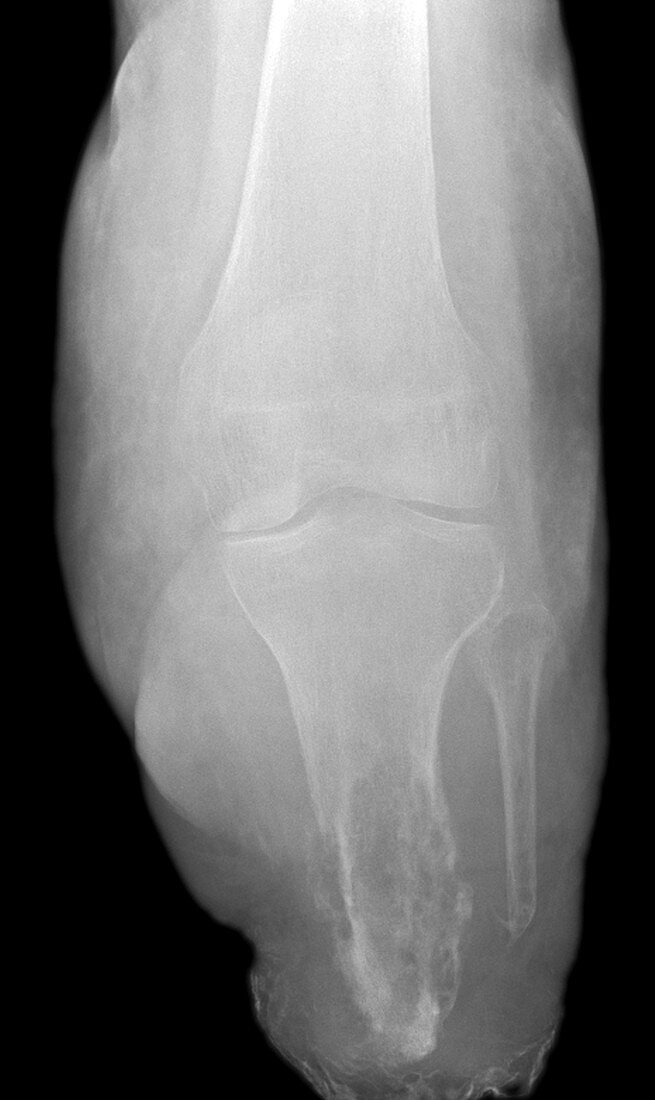 Bone infection,X-ray