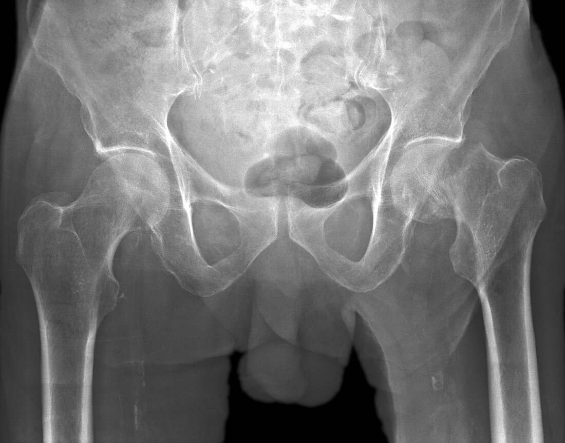 Broken hip,X-ray