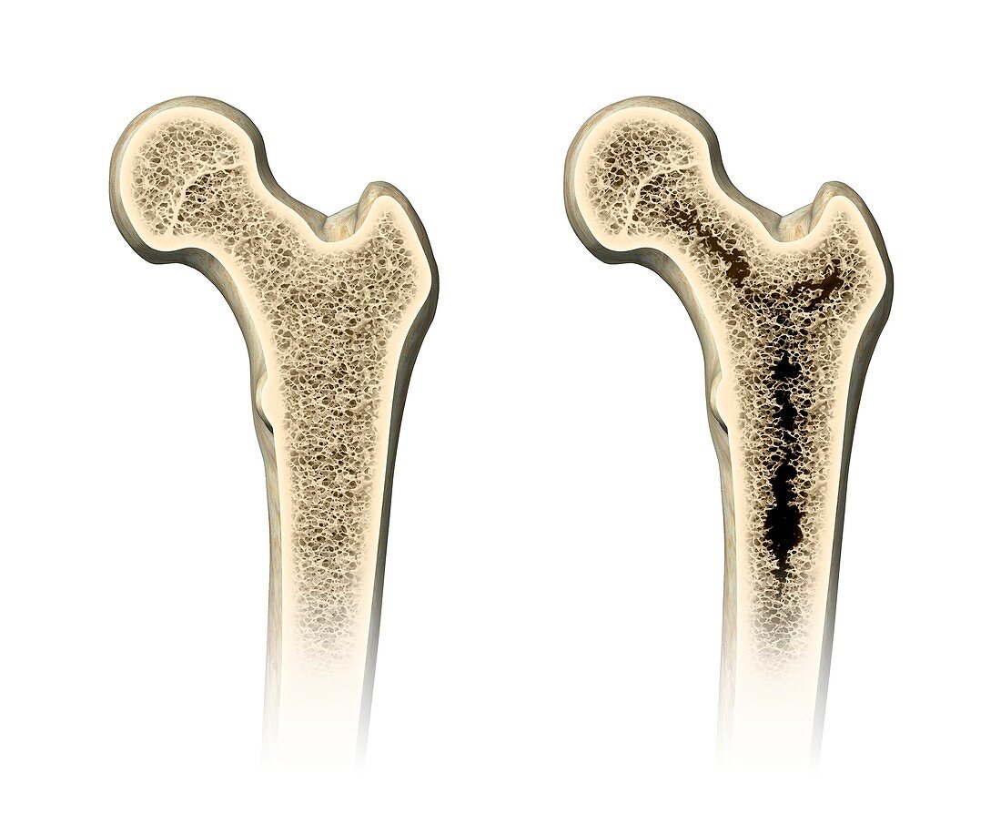 Osteoporosis,artwork