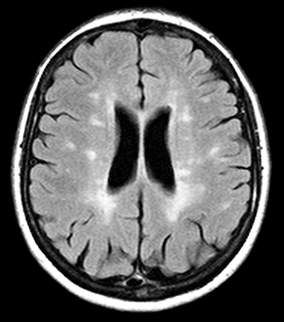 Multiple sclerosis,MRI scan