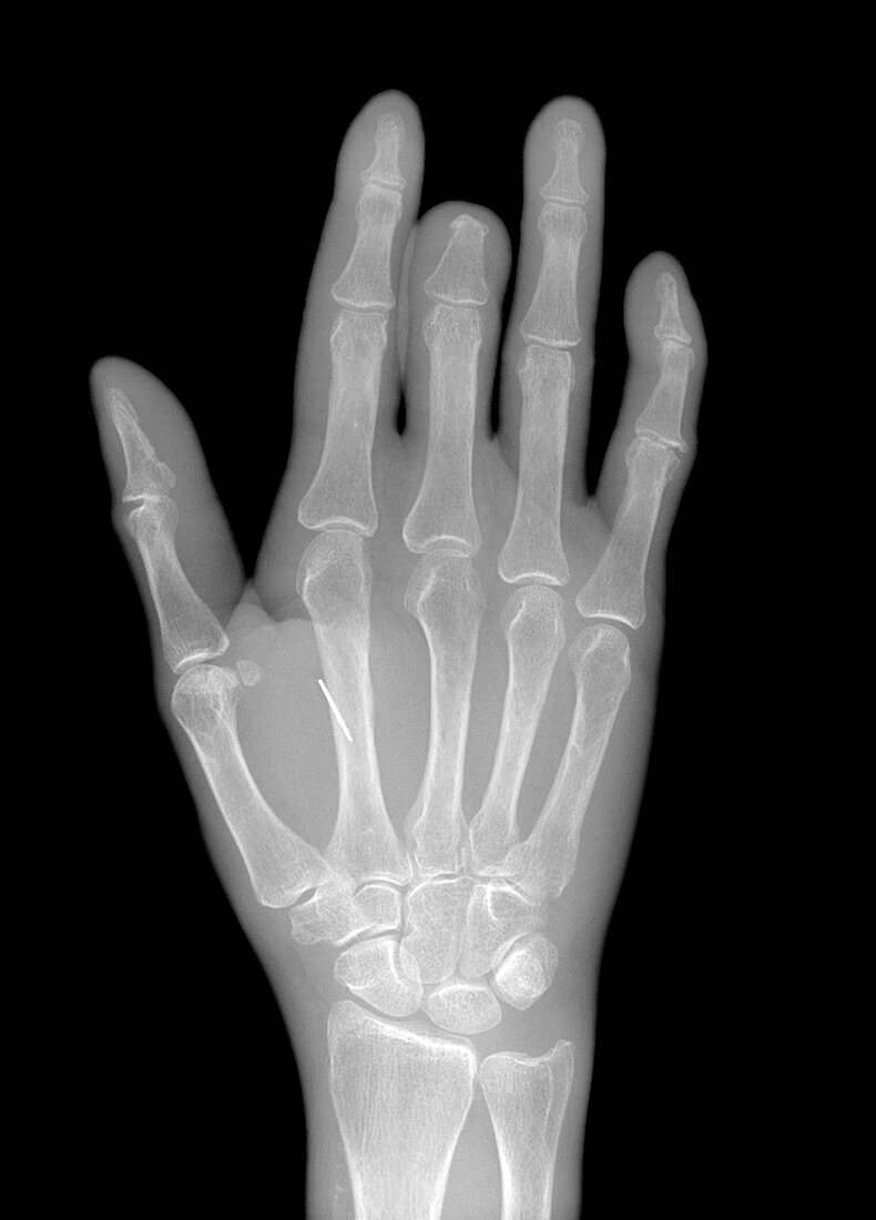 Needle stuck in hand,X-ray