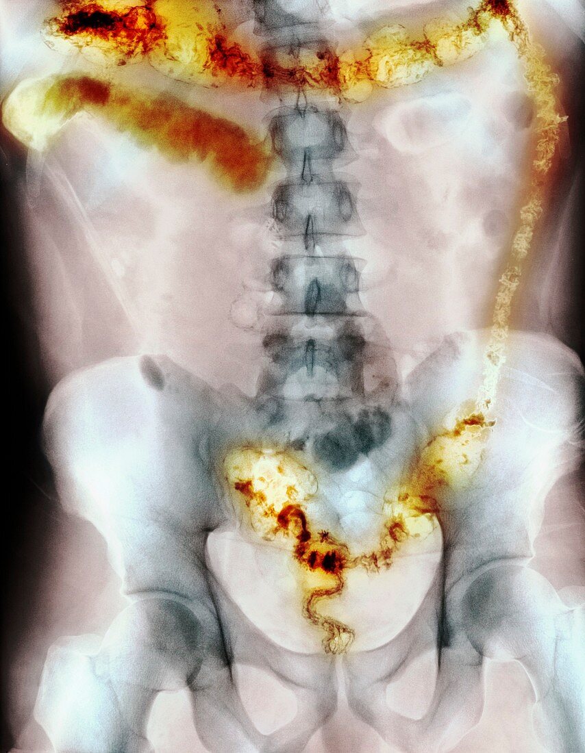 Ulcerative colitis,X-ray