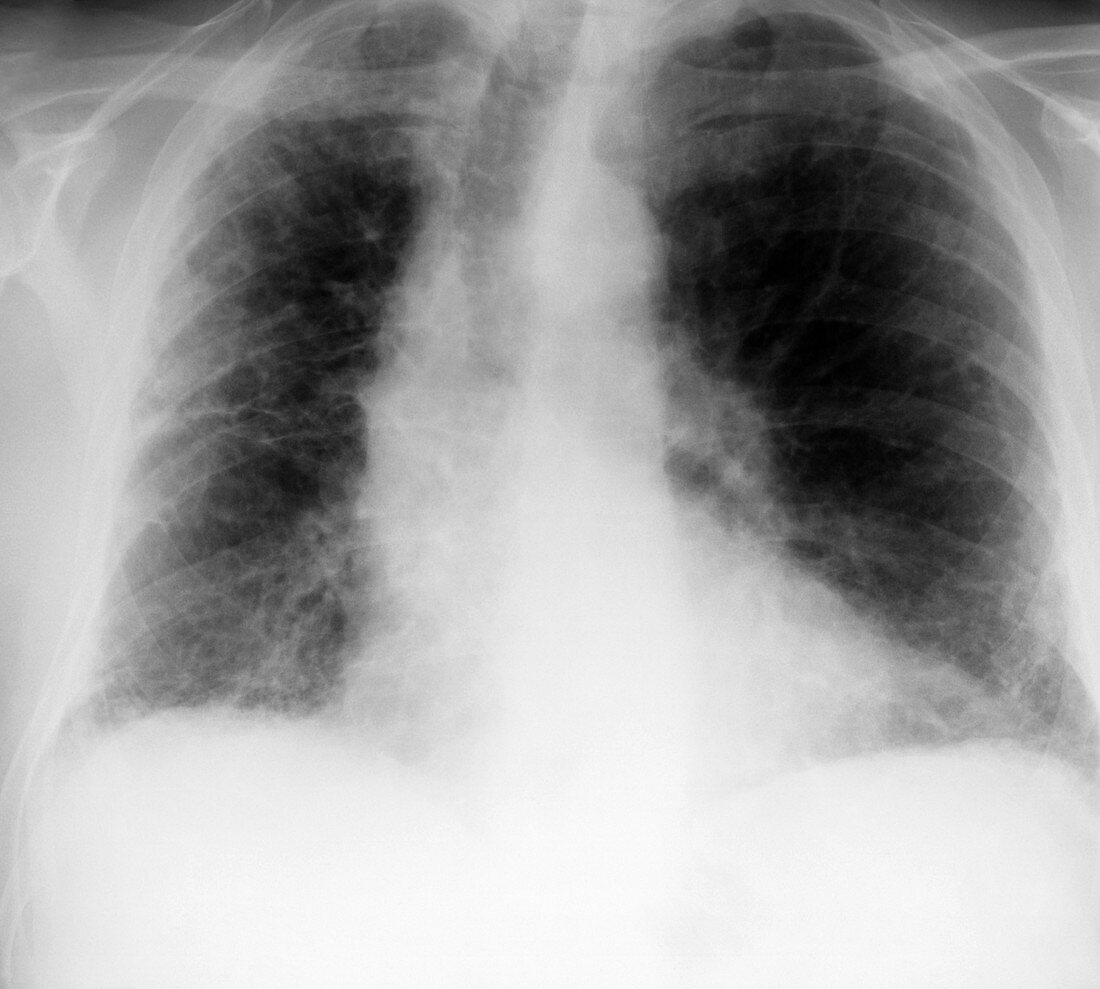 Fibrosing alveolitis,X-ray