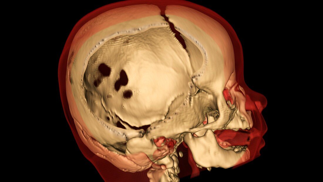 Child's skull,3D CT scan