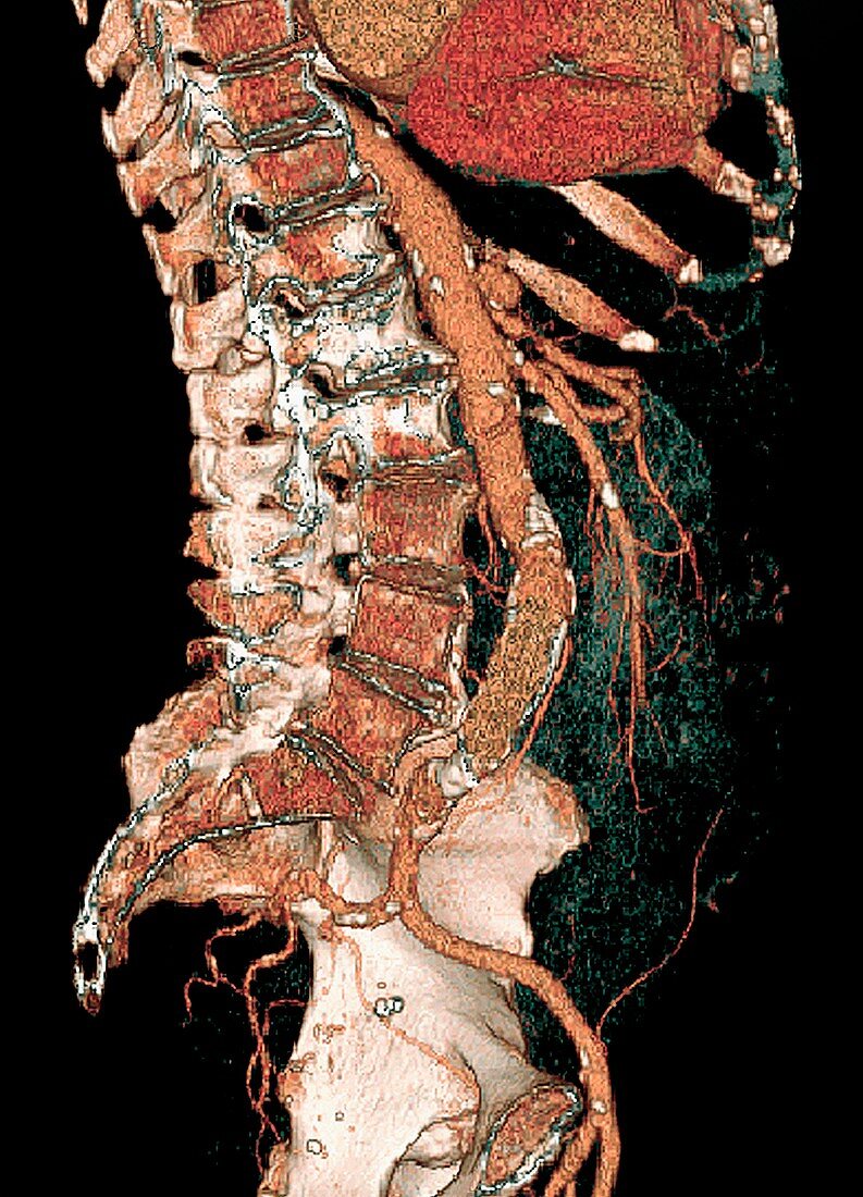 Heart and aortic artery,3D CT scan