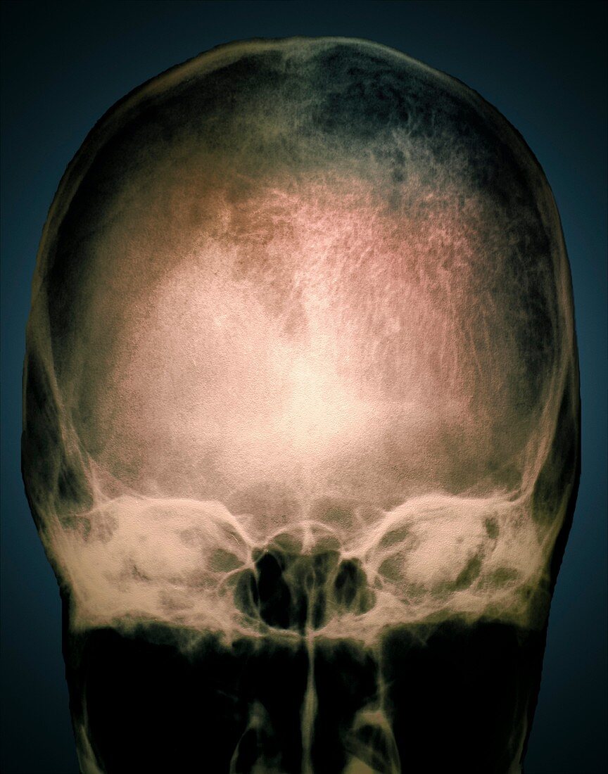 Osteoporosis in the skull,X-ray