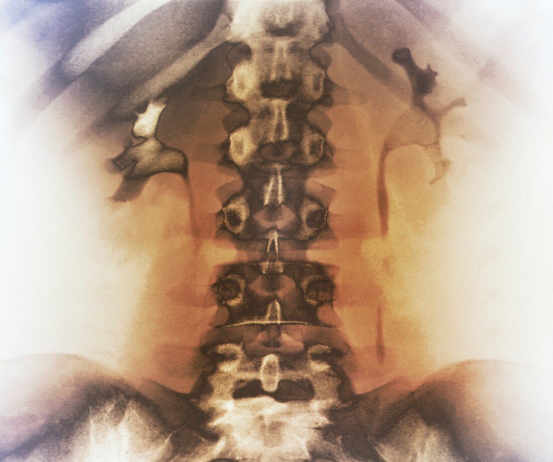 Kidney stones,X-ray