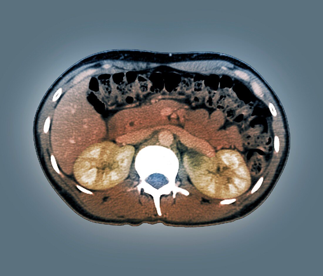 Medullary sponge kidney,CT scan