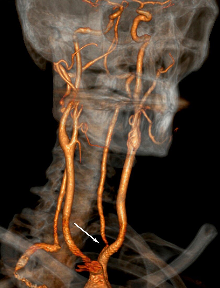 Stenosis of carotid artery,CT scan